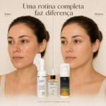 Kit SkinCare para Acne –  Cleanser Mousse + Sérum Facial Antiacne + Creme Facial Tucumã | Rotina Completa de Cuidados com a Pele ALTHER (cópia) - Imagem 3